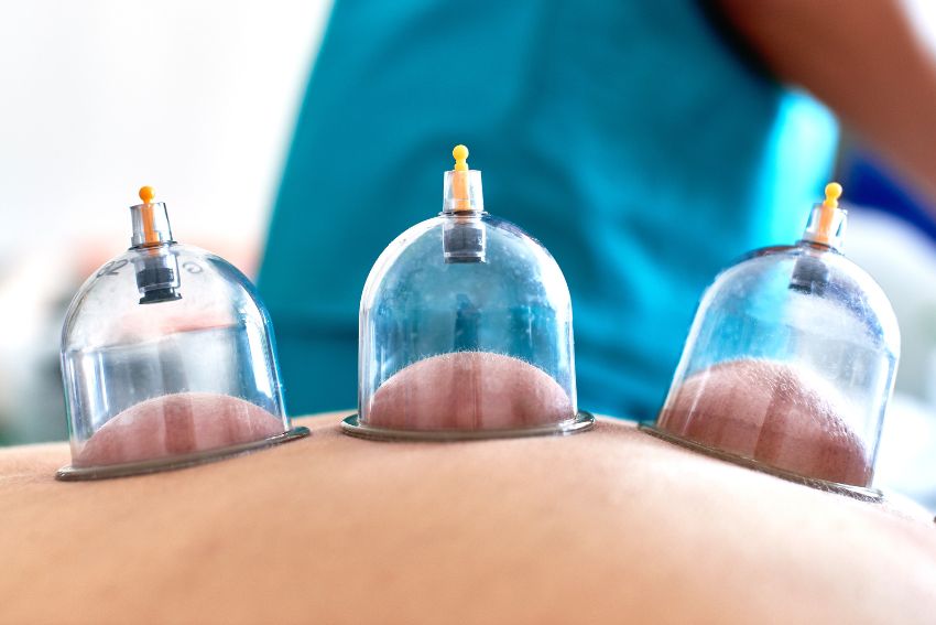 Dry cupping in Lahore for natural pain relief and improved blood circulation at Body Revive.
