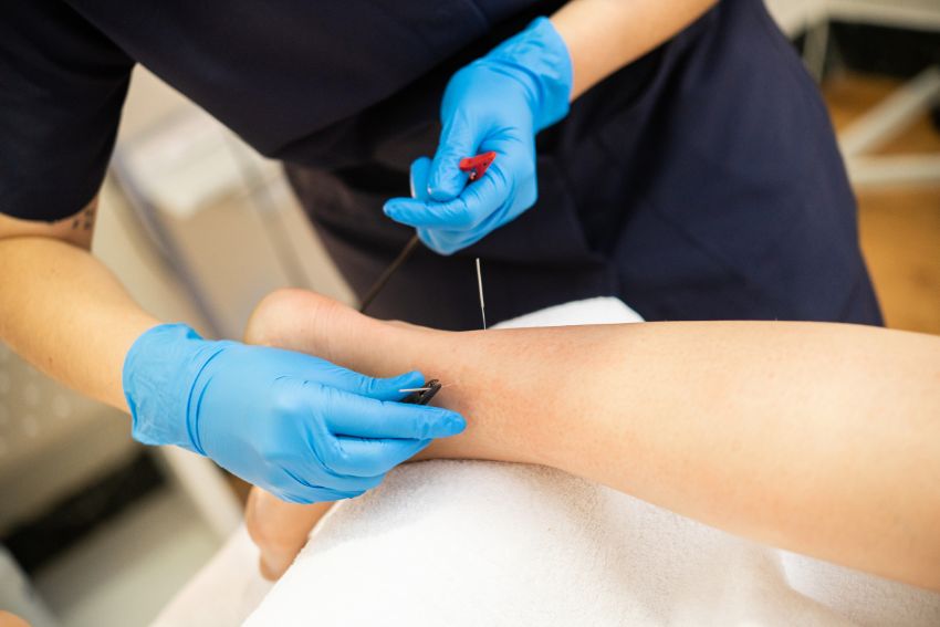 Dry needling in Lahore for muscle pain relief and trigger point therapy at Body Revive.