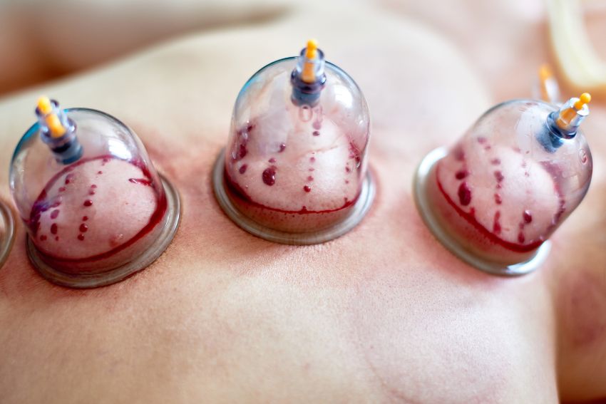 Hijama therapy in Lahore – Wet cupping at Body Revive Center